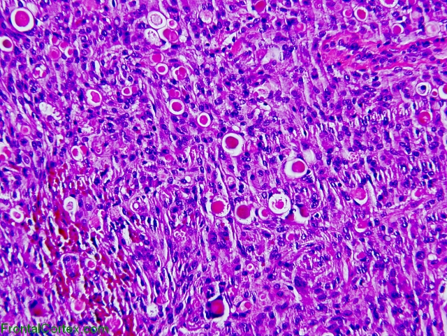 Secretory meningioma, H&E stain x200